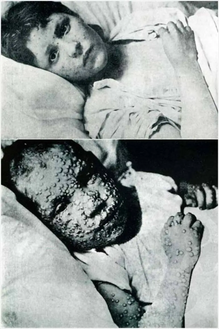 Image: Smallpox