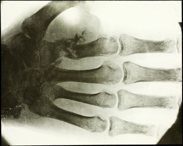 Image: An x-ray image of a shattered index finger bone