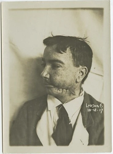 Wounded soldier Image: Wounded soldier