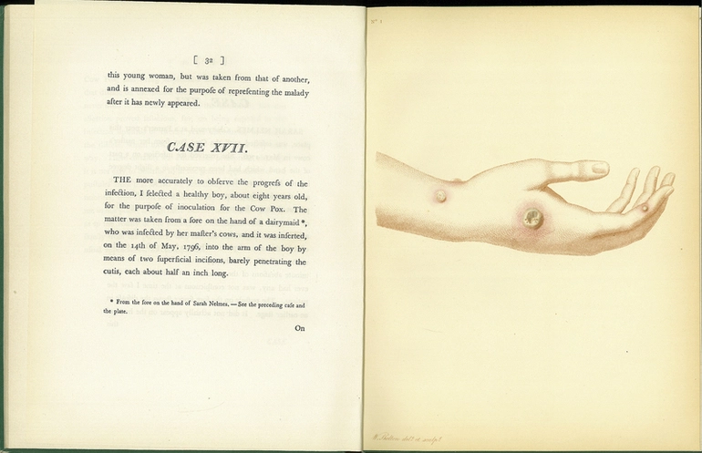 Image: An Inquiry into the Causes and Effects of the Variolae Vaccinae (facsimile)