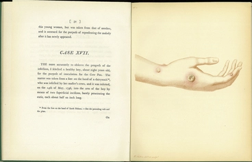 An Inquiry into the Causes and Effects of the Variolae Vaccinae (facsimile) Image: An Inquiry into the Causes and Effects of the Variolae Vaccinae (facsimile)