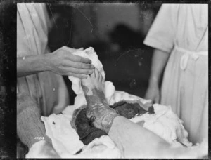 Soldier's ankle wounded by gun shot, during World War 1