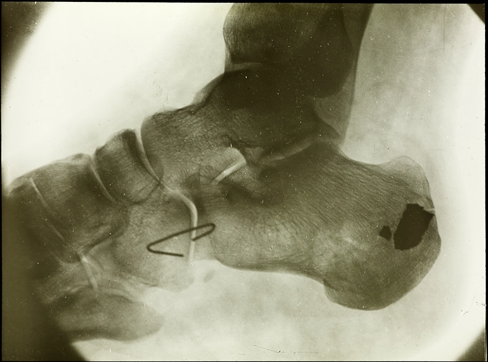 An x-ray of the lower spine and shrapnel
