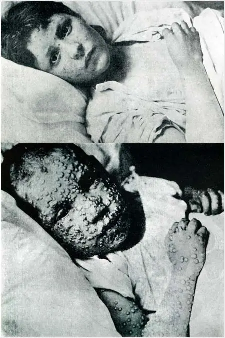 Smallpox